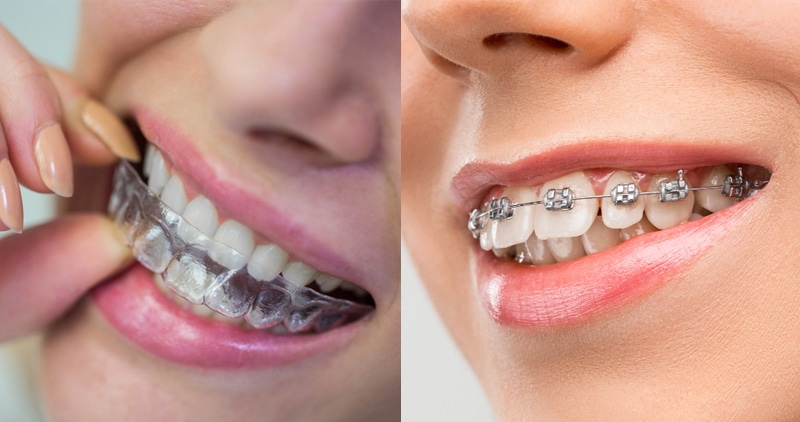 Read more about the article Braces, Aligners, or Both? The Best Orthodontic Options for Teens Today