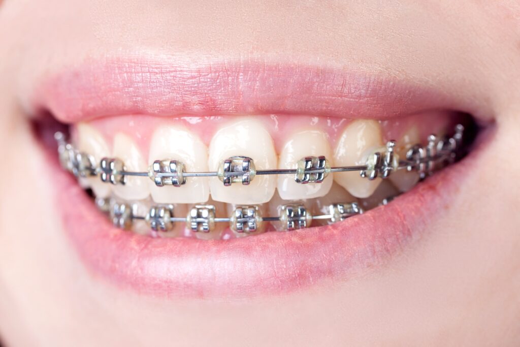 Close-up of teeth fitted with traditional metal braces used to correct complex alignment and bite issues