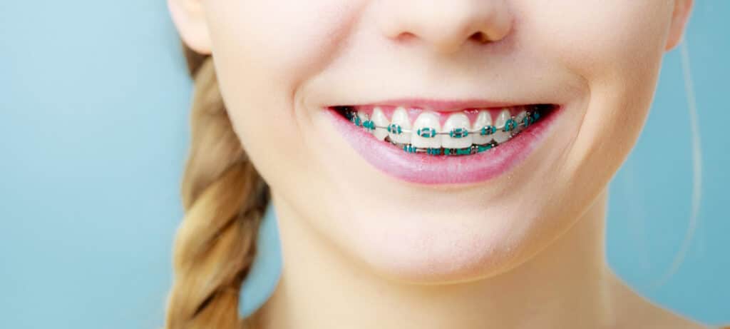 Smiling child wearing orthodontic braces on their teeth