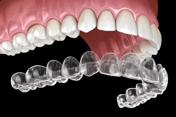 Clear aligner trays positioned in front of upper and lower teeth