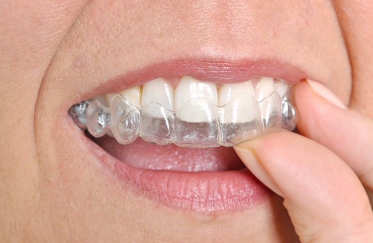 Read more about the article How Invisalign Moves Teeth: The Science Behind the System